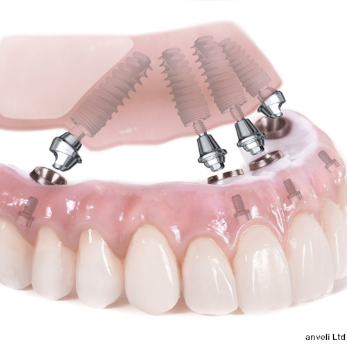 Definition of a Fixed Prosthesis on Dental Implants