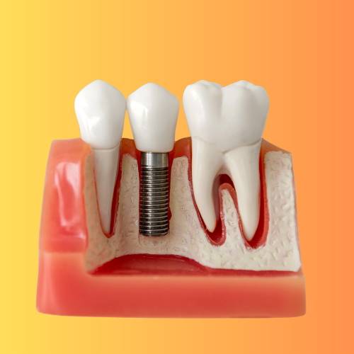 Jaw model with dental implant in the middle.