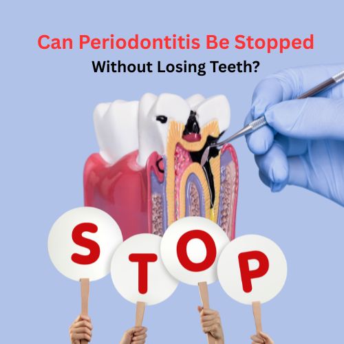 Illustration showing gum disease treatment with the question “Can you stop periodontal disease?” to highlight early intervention strategies.