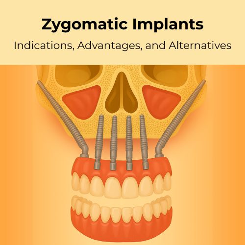 Illustration of zygomatic implants used for full arch dental implants in patients with severe bone loss.